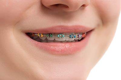 Metal Braces